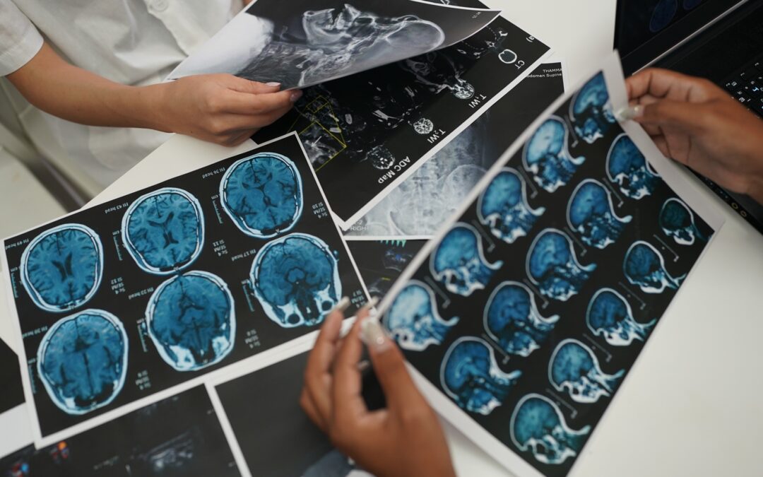 Average Mild Traumatic Brain Injury Settlements in Connecticut